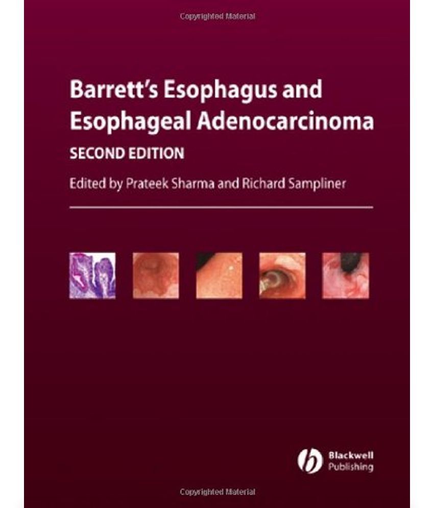 Barretts Esophagus and Esophageal Adenocarcinoma Buy Barretts