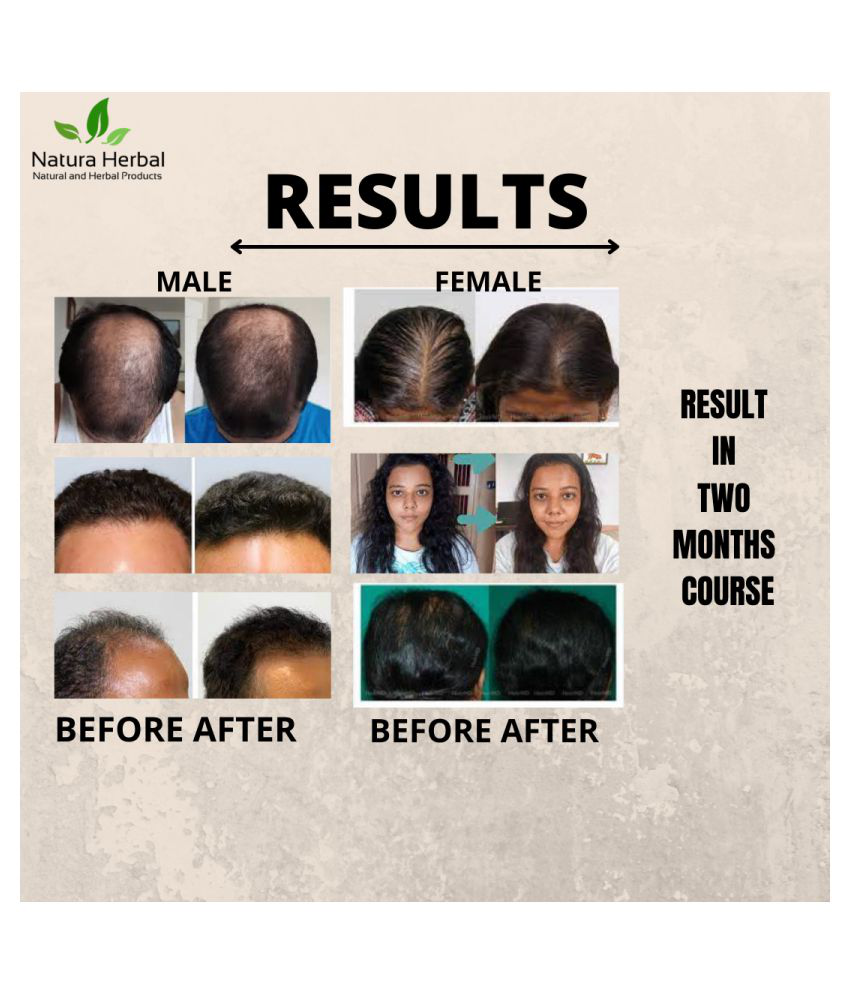 Natura Herbal Hair Regrowth Plus Capsules for Hair Growth 500 mg Vitamins  Capsule Pack of 2: Buy Natura Herbal Hair Regrowth Plus Capsules for Hair  Growth 500 mg Vitamins Capsule Pack of